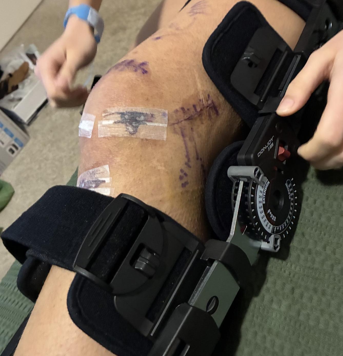 Massmann's left knee post surgery and in a stabilizing cast. Image provided by Sam Massmann